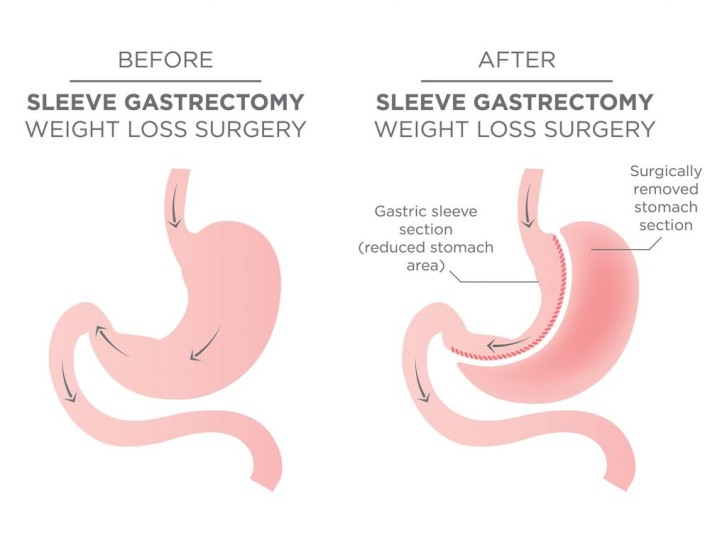 Before and After Sleeve Gastrectomy Weigh Loss Surgery Before and After Sleeve Gastrectomy Weigh Loss Surgery